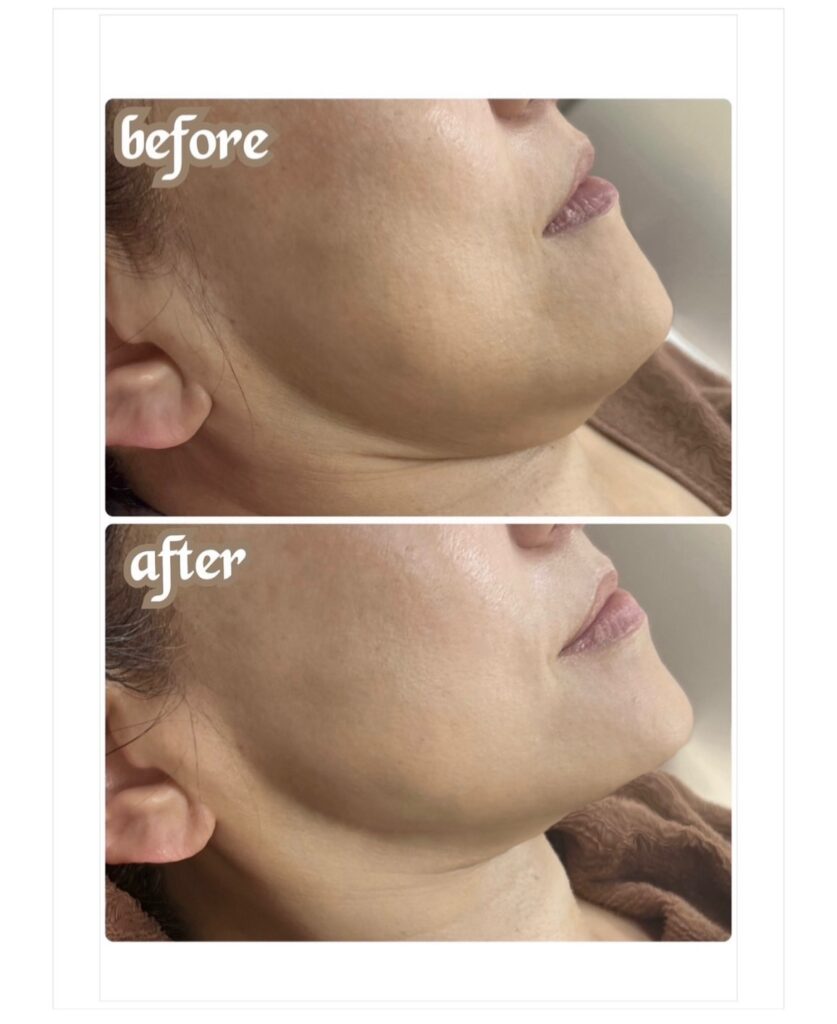 埼玉のたるみケア