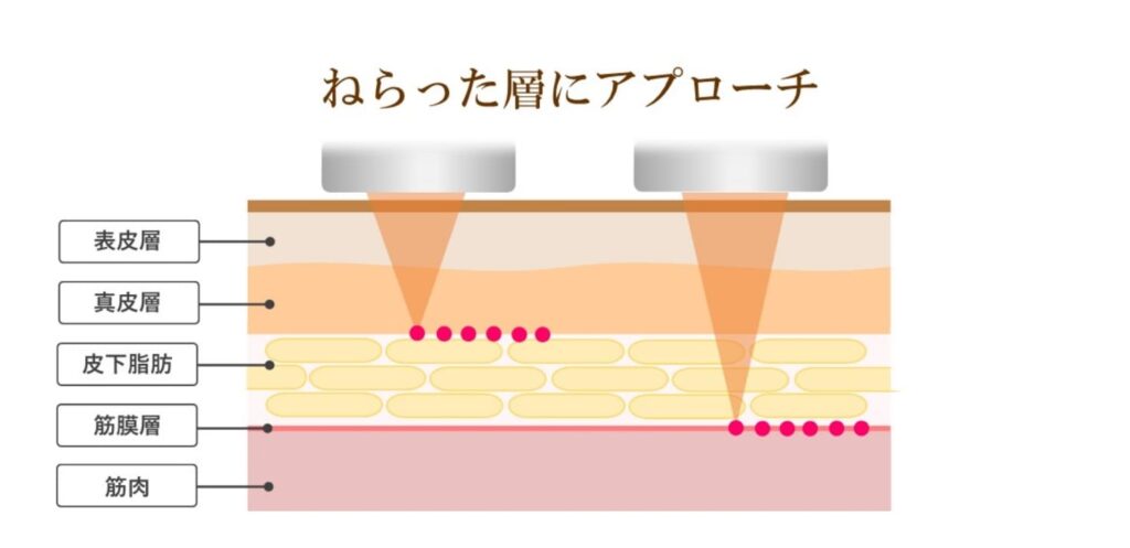 埼玉・千葉のシミ取り放題×たるみケアコースのプラズマ
